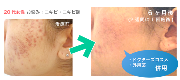 医療用Wピーリング（ケミカルピーリング）症例