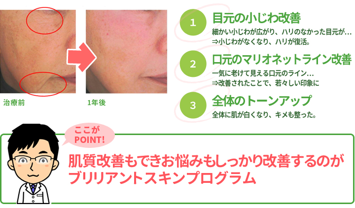 ブリリアントスキンプログラム