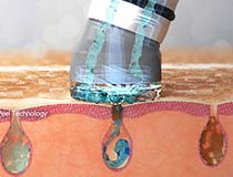 【STEP２】吸引(バキューム)